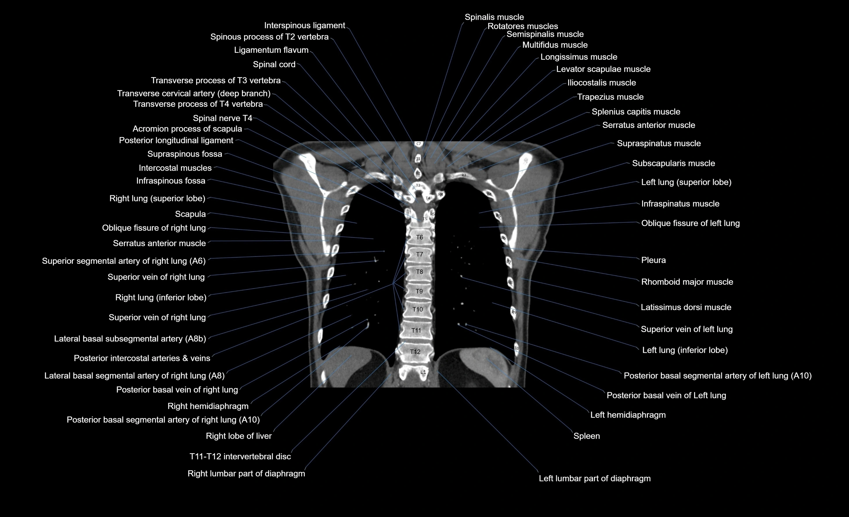 CT chest (thorax) soft tissue window labelled coronal cross sectional anatomy radiology image-00031.webp